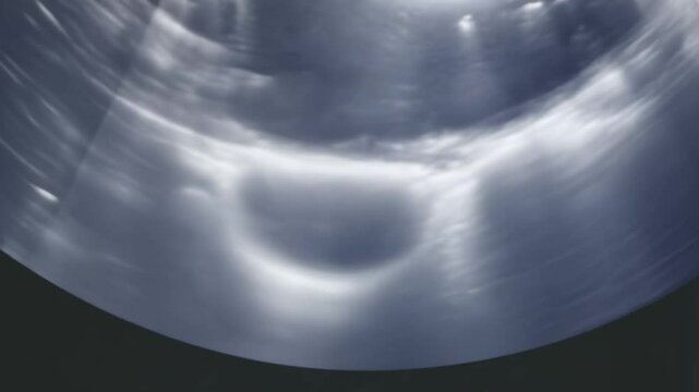 Ultrasound examination showing empty urinary bladder
