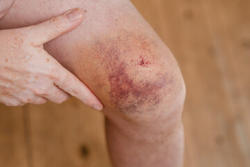 Fototapeta premium Knie nach Fahrradunfall, Hämatom in schillernden Farben am Kniegelenk, Bluterguss am Männerknie
