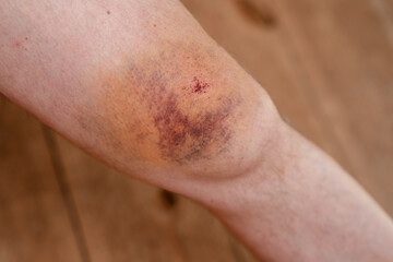 Fototapeta premium Knie nach Fahrradunfall, Hämatom in schillernden Farben am Kniegelenk, Bluterguss am Männerknie