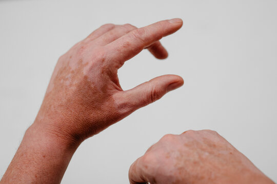 M&auml;nnerh&auml;nde mit Weissfleckenkrankheit, Vitiligo an den H&auml;nden als chronische Hauterkrankung, die durch Pigmentst&ouml;rungen einen Pigmentverlust gekennzeichnet ist