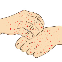 Eczema or allergy rash red on hand, itching from urticaria or atopic dermatitis, illustration on white background