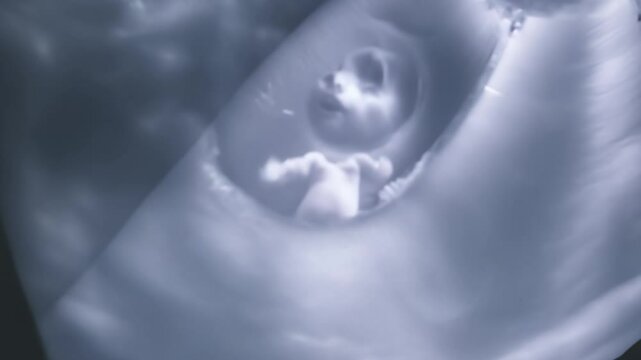 Ultrasound showing fetus moving in uterus