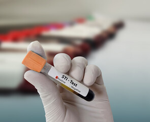 Doctor hold Blood sample for STI (Sexually Transmitted Infection) Test. Positive result test tube. © Innovative Creation