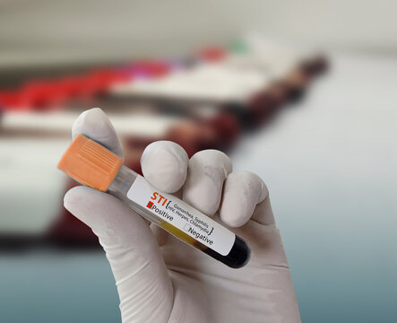 Doctor hold Blood sample for STI (Sexually Transmitted Infection) Test. Positive result test tube.
