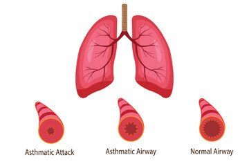illustration of asthmatic airway,  medical illustration. eps 10