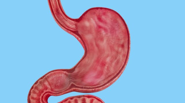 Stomach cancer. stages tumor growth in digestive system. The concept of diseases in the human stomach