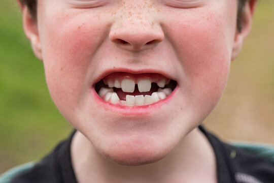 Child with Missing Tooth Smiling Outside with Freckles in Bike Day