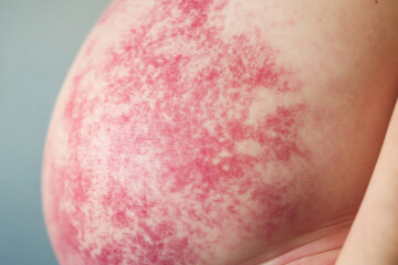 Fototapeta premium Skin allergy rash dermatitis texture close up background 