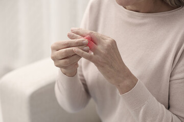 Woman with joint inflammation indoors, closeup. Red area on finger