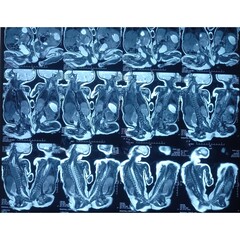 Conjoined twin girls MRI imaging. Conjoined buttock twins. Sacrum is deficient, fusion of both fetus by lower posterior part and soft tissue bridging. Finding rised the possibility of conjoined twen.