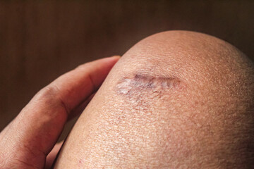 Naklejka premium a stitch scar on the leg
