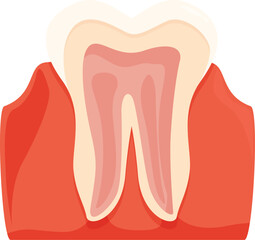 Medical illustration showing periodontitis affecting a human tooth, causing inflammation and receding gums