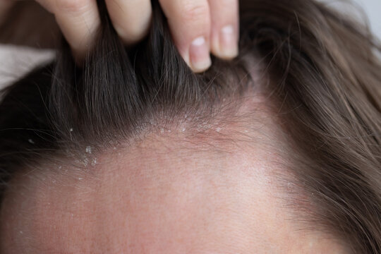 Closeup dandruff flakes on the scalp and on the hair.
