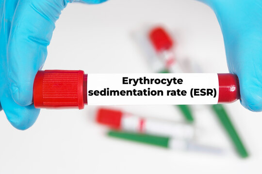Erythrocyte sedimentation rate (ESR) medical analysis value test tube background