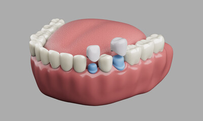 Partial dentures. 3D render. human teeth. health care