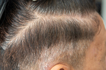 Close-up of a person's scalp, showing thinning hair, gray hair, flaky white scalp and dandruff,...