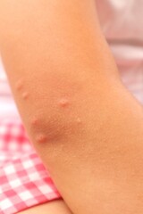 Elbow arm of a toddler girl suffering from chicken pox or varicella caused by the Varicella zoster virus, close-up view.
