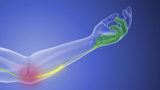 Nerve Compression Issues in Cubital Tunnel Syndrome.