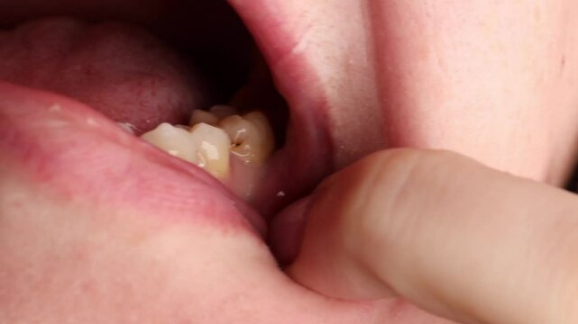 Dental caries under filling with visible cavity in close-up. Decayed tooth highlights poor oral hygiene and gum inflammation. dental damage, concept