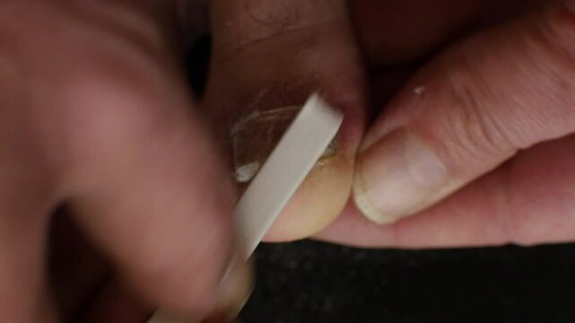 Close-up of a big toe fungal infection being filed down with a small nail file