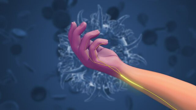 Effects of Guillain Barre Syndrome on Body Sensations