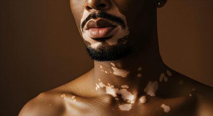 Man showing vitiligo depigmentation on face and neck