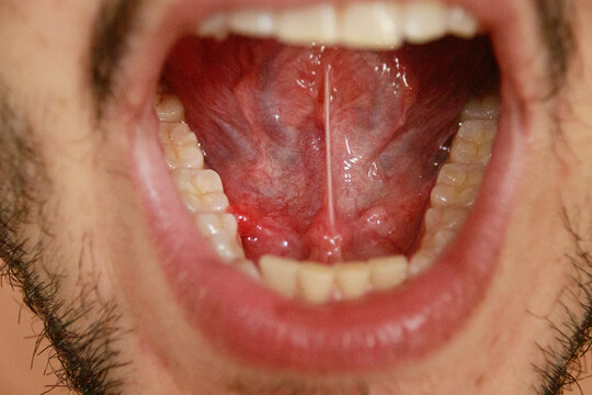 Close-up view of an open human mouth with the tongue lifted showing multiple oral mucocoele also known as a mucous cyst that appear as fluid-filled sacs that are translucent