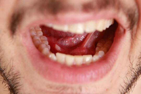 View of the open mouth with the tongue lifted, showing a salivary stone or sialoliths partially visible through the opening of the submandibular duct