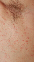 Pityriasis rosea rash on caucasian skin near the armpit that usually result from an immune response or allergy