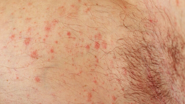 Close up to caucasian skin with red rashes called hives or urticaria