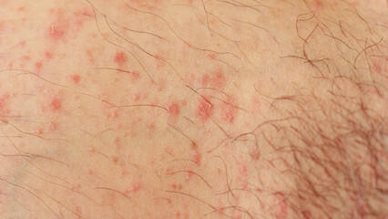 Fototapeta premium Close up of hives or urticaria on caucasian skin