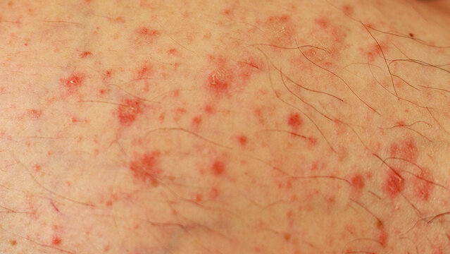 Close-up of Caucasian skin with urticarial vasculitis, rare skin condition with raised red patches and hives