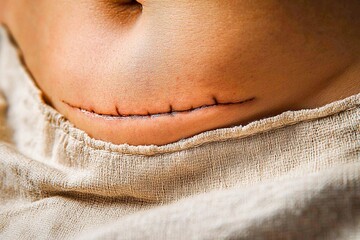 Closeup of woman showing on her belly dark scar from a cesarean section. Healthcare concept