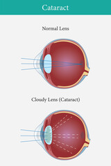 Fototapeta premium illustration of cataract in human eyes. eye vision disorder. vector illustration