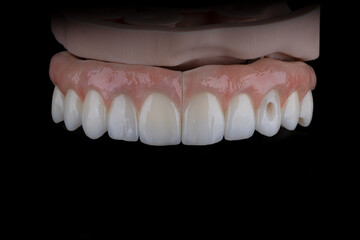 Full dental zirkonium prosthesis on titanium bar stained with stains for ceramic