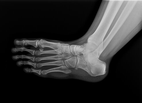 human foot ankel and leg xray picture