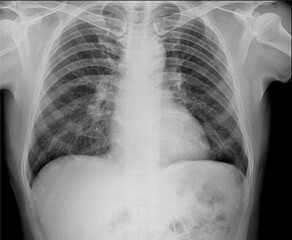 photo x ray of infected lungs