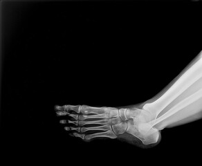 human foot ankel and leg xray picture