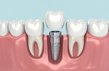 a dental implant and teeth on a light blue background.