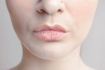 Dry, cracked lips in woman. Cold, wind, dryness close up photo need a hydrating, hygienic lip balm