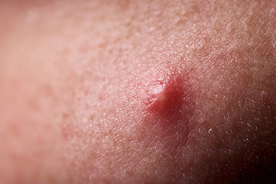 Pimple on the skin. Acne is an infection that can lead to pimple popping on the face. Acne occurs on the lower face. Close-up of a furuncle, an acne pimple with pus under the skin