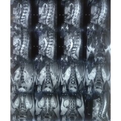 MRI scan of lumbosacral (LS) spine, case of lumbar spondylosis and osteoporotic vertebral...