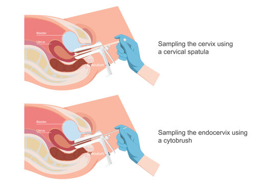 Sampling the endocervix using the endocervical brush and using the cytobrush.