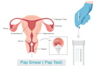 Sampling the endocervix using the cervical brush and cell.