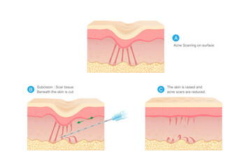 Reduce acne scar with micro surgical technique that called Subcision. 3 steps of cuting fibrous bands under skin layers tethered down for treatment acne scar.