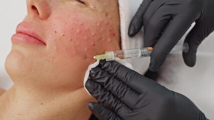 Professional cosmetologist injecting a woman's facial skin with a syringe for anti-aging procedures, wrinkle removal, and rejuvenation in a beauty clinic. High quality 4k footage