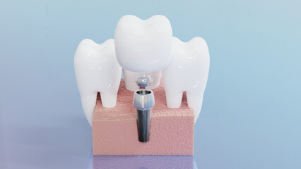 Dental Implants surgery concept, dentistry denture, Dental denture on blue background. 3D render.