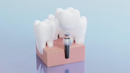 Dental Implants surgery concept, dentistry denture, Dental denture on blue background. 3D render.