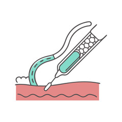 Balloon Angioplasty Procedure with Stent in Vein