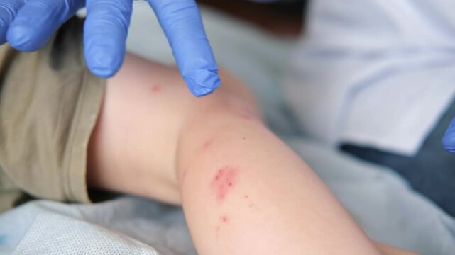 Doctor examining child with bodily red rash. Kid allergy closeup. Little baby scratches an eruption. Nurse applies special cream to atopic skin. Dermatitis, irritation, hive. Pruritus. Mosquito bites